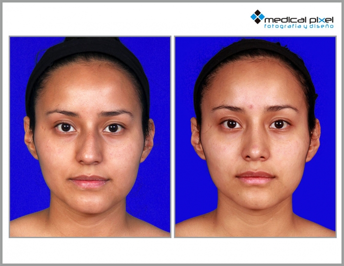 cirugia-de-nariz-estetica-rinoplastia-bogota-colombia