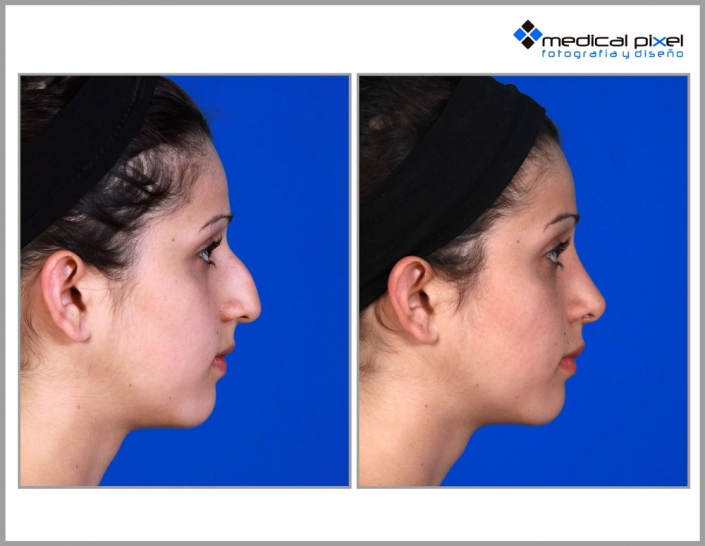 cirugia-de-nariz-estetica-rinoplastia-bogota-colombia