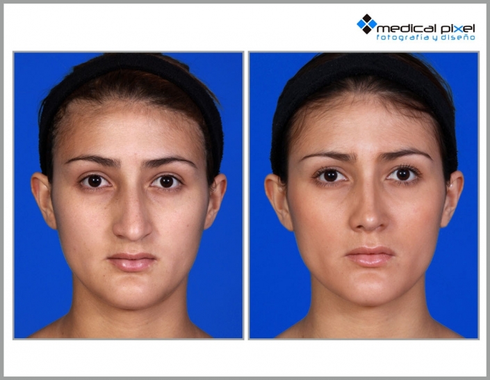 cirugia-de-nariz-estetica-rinoplastia-bogota-colombia