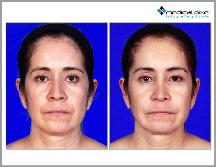 cirugia-de-nariz-estetica-rinoplastia-bogota-colombia