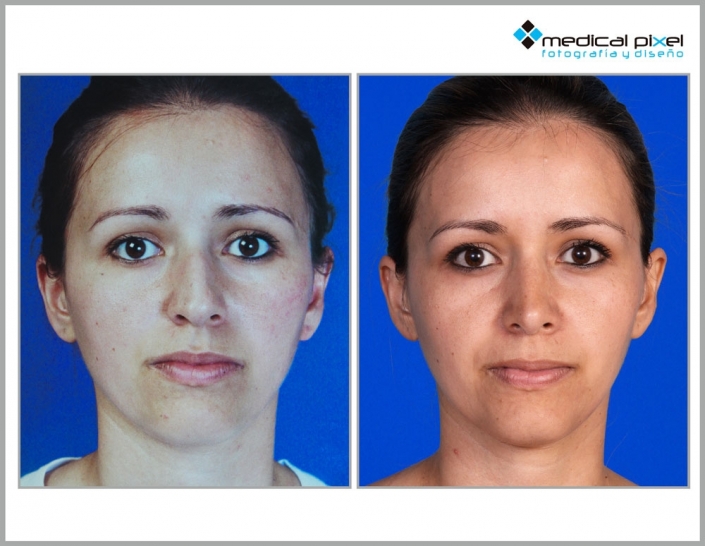 cirugia-de-nariz-estetica-rinoplastia-bogota-colombia