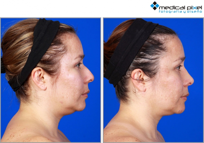 cirugia-de-nariz-estetica-rinoplastia-bogota-colombia