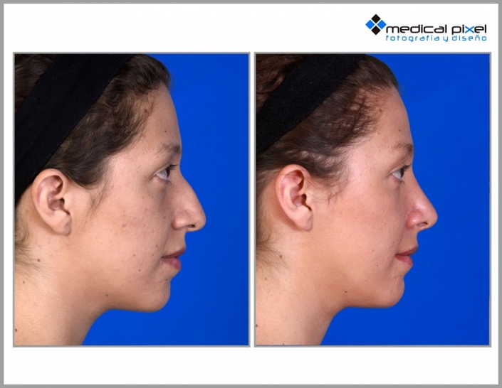 cirugia-de-nariz-estetica-rinoplastia-bogota-colombia